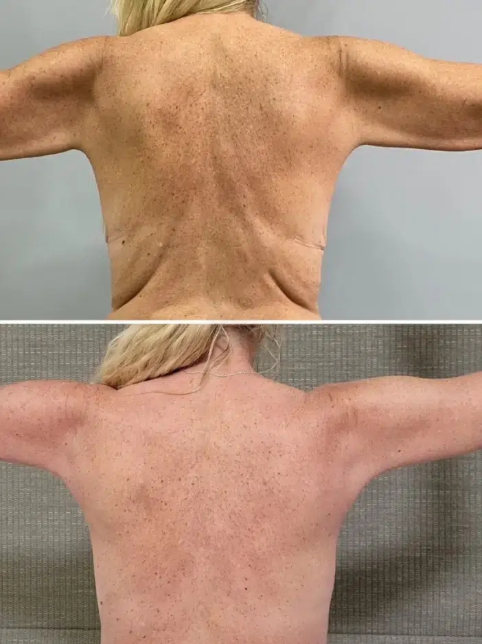Arm Lift