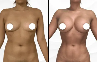 Liposuction 360