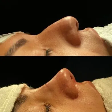 Rhinoplasty