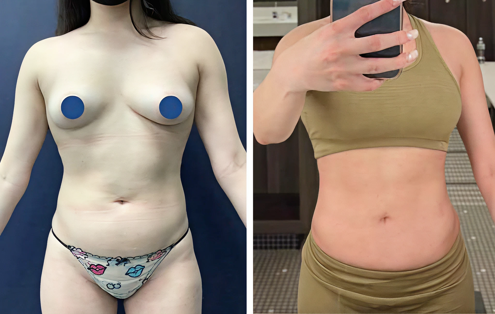 Lipo 360 colombia