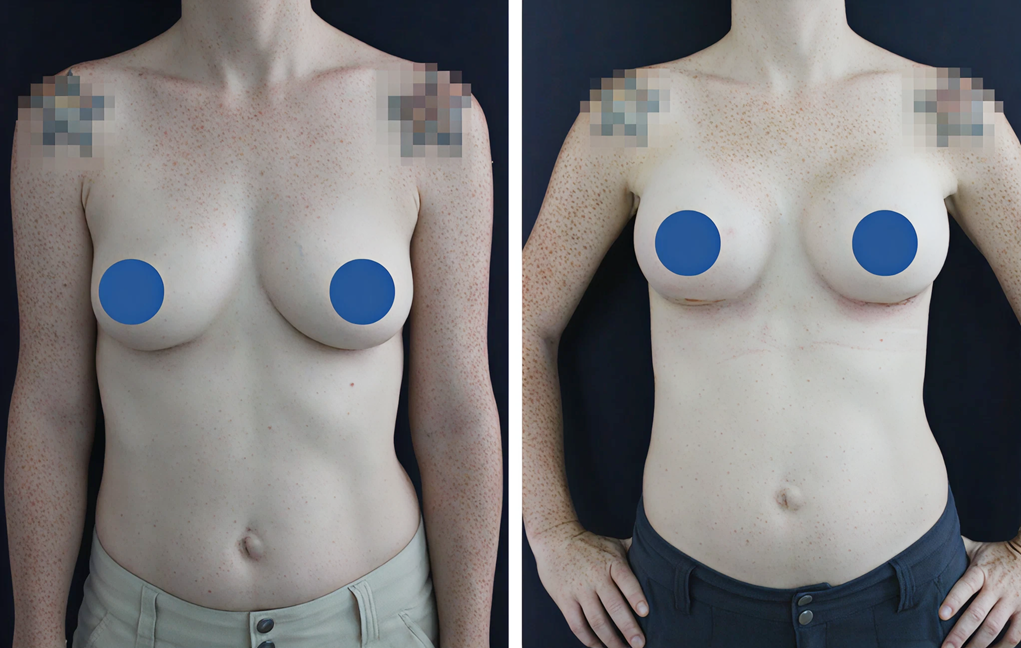 breast aug colombia