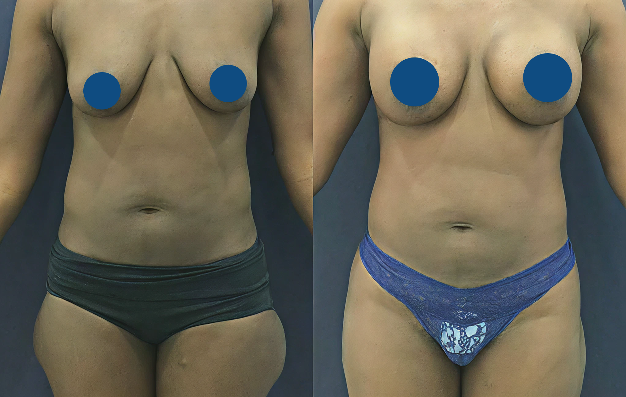 breast lift with implants