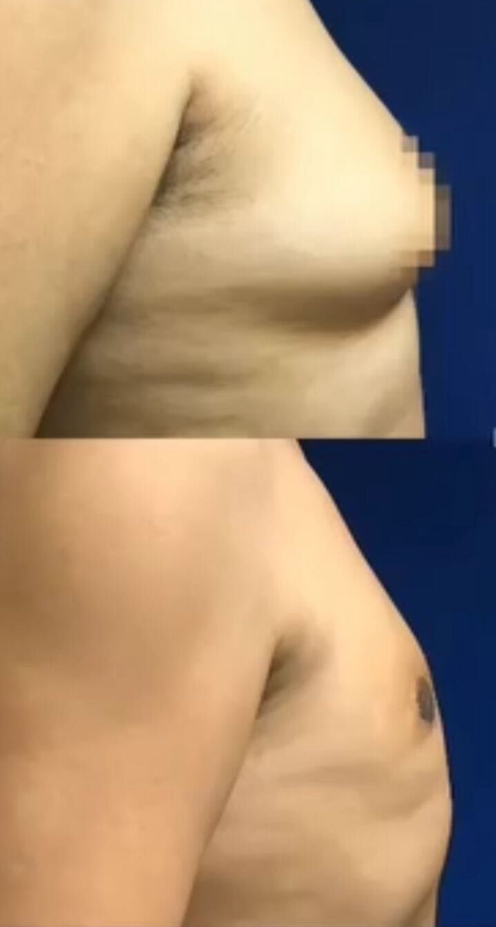 Mens Plastic Surgery Gynecomasty 5 with Dr Flores in Tijuana Mexico