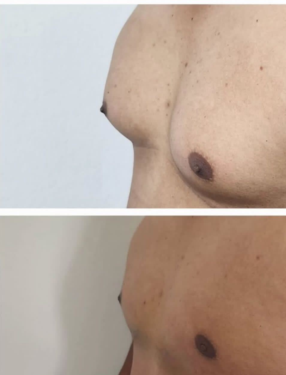Mens Plastic Surgery Gynecomasty 6 with Dr Flores in Tijuana Mexico