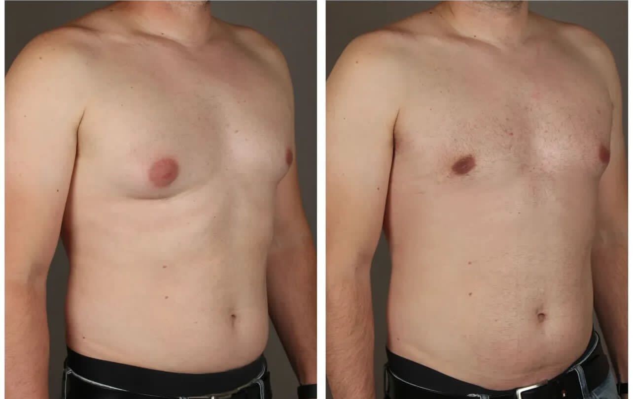 Mens Plastic Surgery Gynecomasty 7 with Dr Flores in Tijuana Mexico