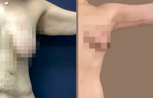 Arm Lift in Colombia