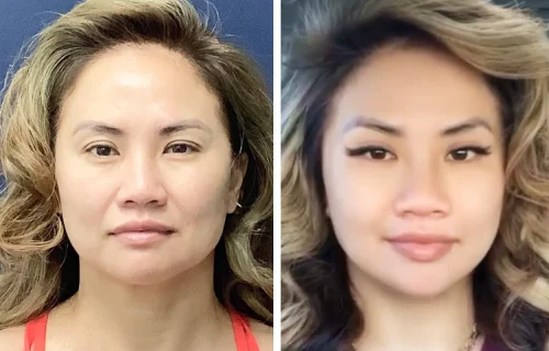 Plastic Surgery Face Lift Colombia