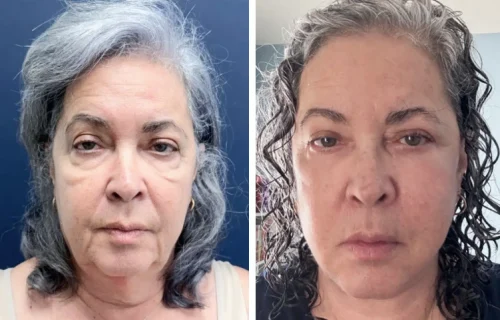 Plastic Surgery Face Lift Colombia