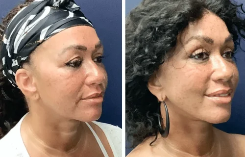Plastic Surgery Face Lift Colombia