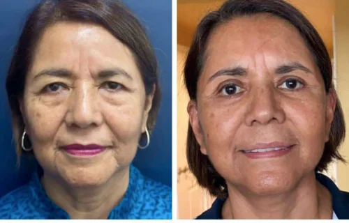 Plastic Surgery Face Lift Colombia
