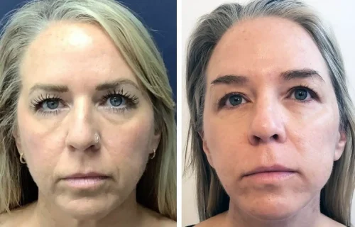 Plastic Surgery Face Lift Colombia