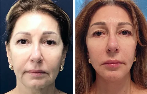 Plastic Surgery Face Lift Colombia