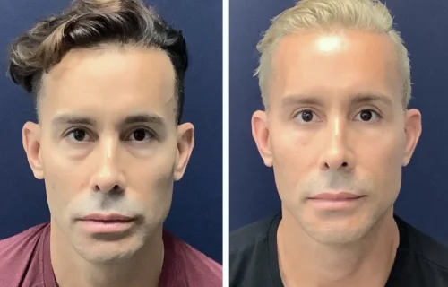 Plastic Surgery Face Lift Colombia