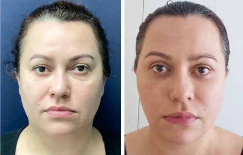 Plastic Surgery Face Lift Colombia