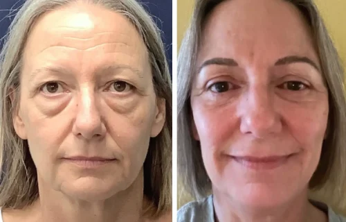 Plastic Surgery Face Lift Colombia