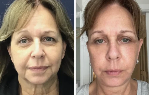 Plastic Surgery Face Lift Colombia