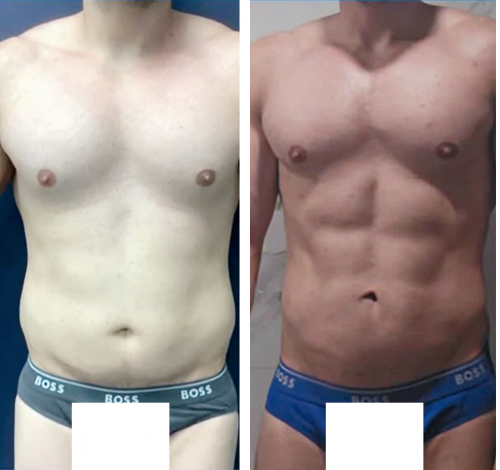 Lipo Colombia 1