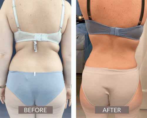 Lipo Colombia 2