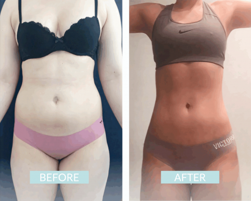 Lipo Colombia 3