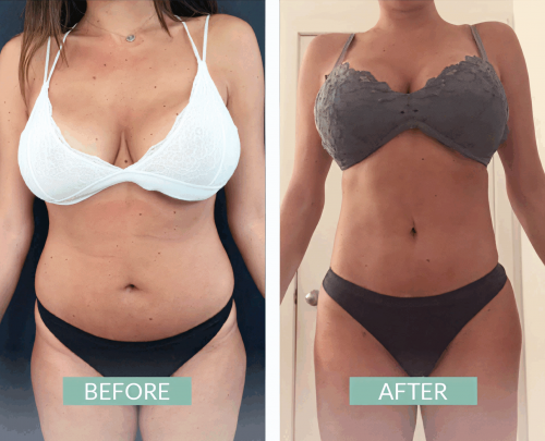 Lipo Colombia 4