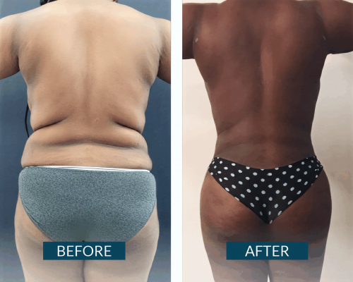 Mommy Makeover Colombia