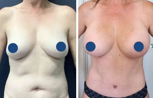 Plastic Surgery Mommy Makeover Cartagena Colombia