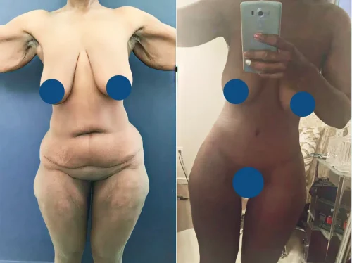 Plastic Surgery Mommy Makeover Cartagena Colombia