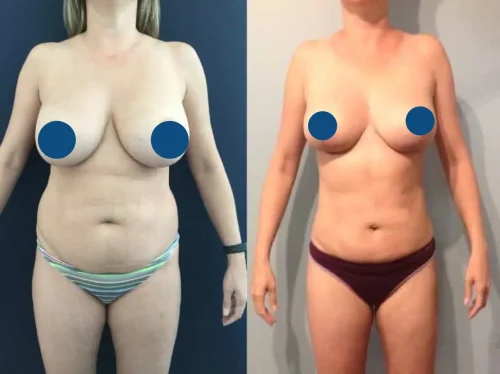 Plastic Surgery Mommy Makeover Cartagena Colombia