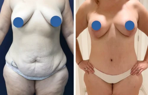 Plastic Surgery Mommy Makeover Cartagena Colombia