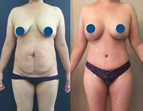 Plastic Surgery Mommy Makeover Cartagena Colombia