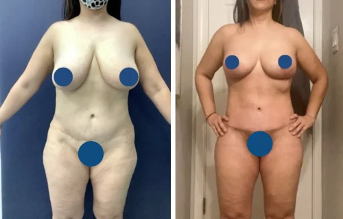 Plastic Surgery Mommy Makeover Cartagena Colombia