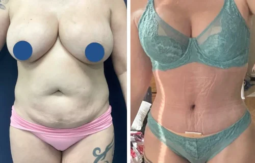 Plastic Surgery Mommy Makeover Cartagena Colombia