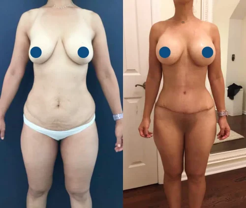 Plastic Surgery Mommy Makeover Cartagena Colombia