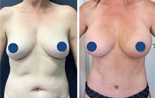 Tummy-Tuck Colombia