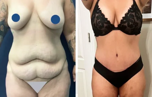 Plastic Surgery Tummy Tuck Colombia