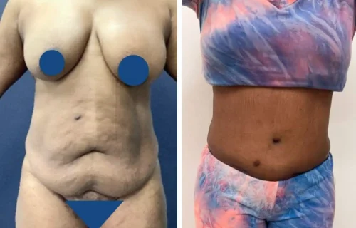 Plastic Surgery Tummy Tuck Colombia