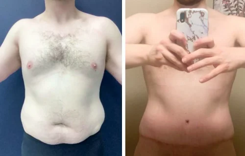 Plastic Surgery Tummy Tuck Colombia