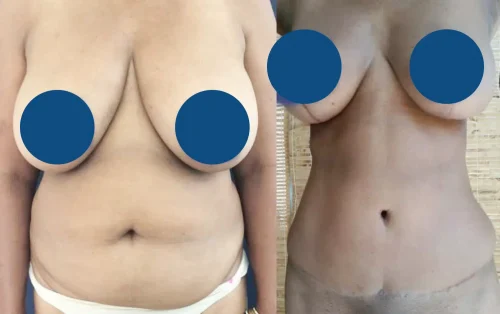 Plastic Surgery Tummy Tuck Colombia