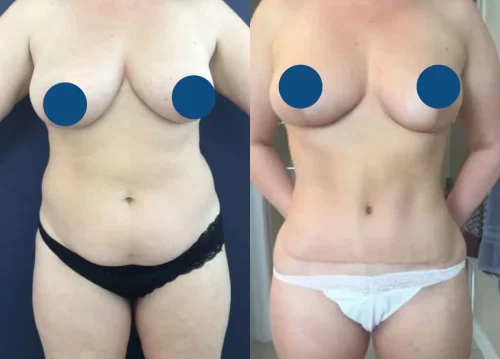 Plastic Surgery Tummy Tuck Colombia