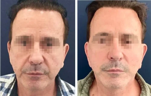 Plastic Surgery Face Lift Colombia