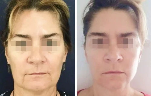 Plastic Surgery Face Lift Colombia