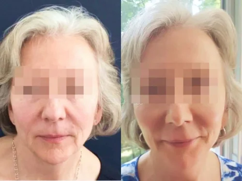 Plastic Surgery Face Lift Colombia