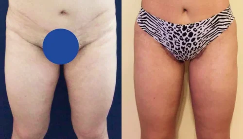 Plastic Surgery Thigh Lift Colombia
