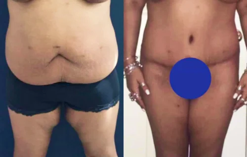 Plastic Surgery Thigh Lift Colombia