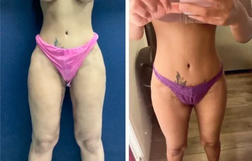 Plastic Surgery Thigh Lift Colombia