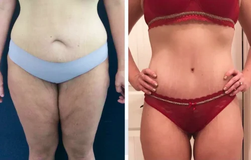 Plastic Surgery Thigh Lift Colombia